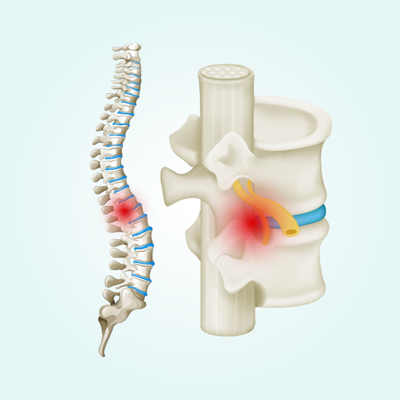 Spinal-Fusion-Patient (1)